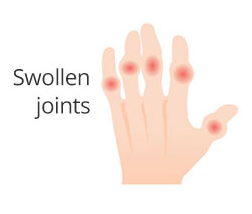 Swollen joints image